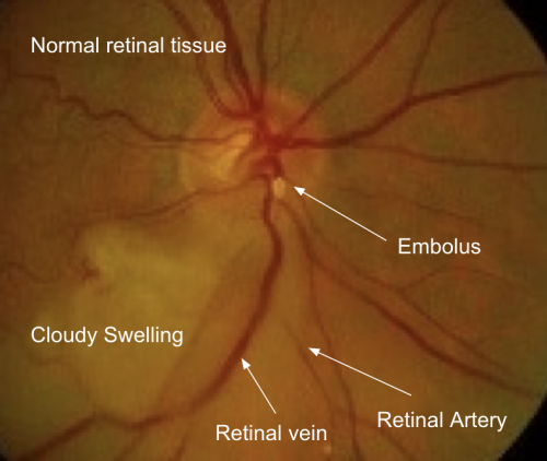 09-2022-acute-visual-loss-labeled