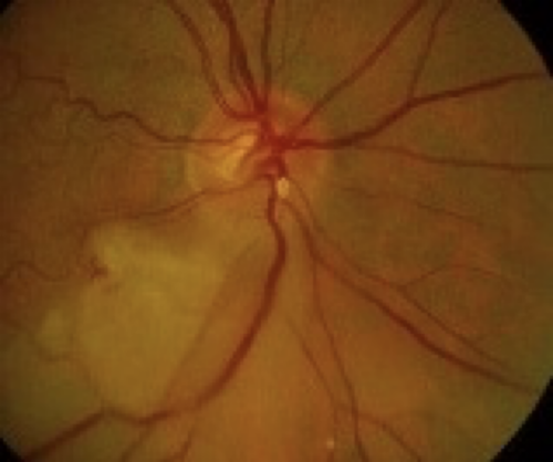 Fundus Image